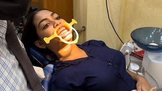 DENTAL BRACES TREATMENT  braces treatment  ORTHODONTIST Treatment  braces ep  15 braces [upl. by Sauer]