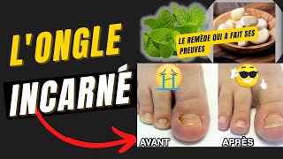 Ongle incarné Remède naturel  remèdedegrandmère [upl. by Leandra]