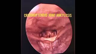 SEE WHAT ANKYLOSIS OF THE CRICOARYTENOID JOINT LOOKS LIKE [upl. by Suedaht818]