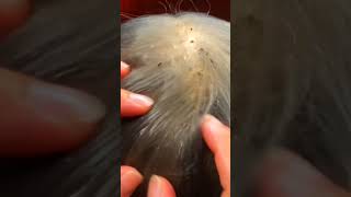 ASMR Lice Scalp Scratching [upl. by Canute41]