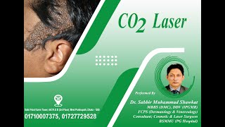 CO2 Laser on Skin Tumour Nevus Sebaceous  Skin Square  Dr Sabbir Muhammad Shawkat [upl. by Vizzone]