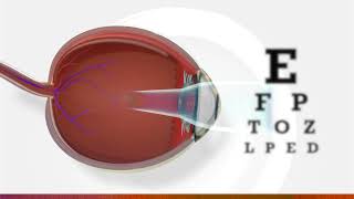 What is myopia  3D animation of myopia [upl. by Onavlis]