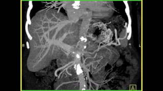 Vascular Superior Mesenteric Vein Clot Interactive rendering with MIP [upl. by Simsar598]