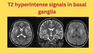 T2 hyperintense signals in basal ganglia [upl. by Orola]