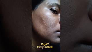 Day30 Using Tretinoin 0025 Cream viralvideo tretinoin skincare shorts youtubeshorts [upl. by Ecallaw931]