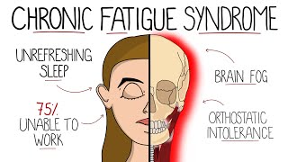 Myalgic Encephalomyelitis Chronic Fatigue Syndrome  Includes Criteria amp Treatment [upl. by Ahsimak]