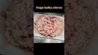 Huge fibroid uterus with secondary changes specimen for histopathology  histopathology [upl. by Kalfas]