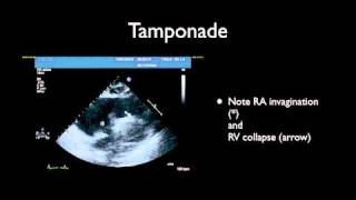 Tamponade amp Pericardiocentesis [upl. by Leverick]