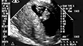 Eleven Week Sonogram [upl. by Kenway556]