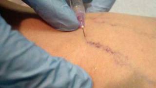 Watch a Live Cosmetic Sclerotherapy Procedure to Treat Spider Veins [upl. by Raina]