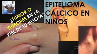 EPITELIOMA CALCICO EN NIÑOS [upl. by Boyt]