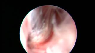 Canine Oronasal Fistulas  Rhinoscopy [upl. by Mccallum]