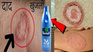 सिर्फ 2 दिन में दाद खाज खुजलीEczemaको जड़ से खत्म करेगा ये घरेलू नुस्खाringworm treatment at home [upl. by Roe824]