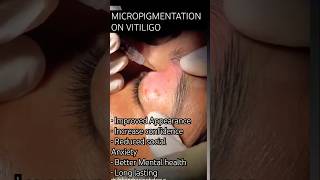 “BOOST your CONFIDENCE with MICROPIGMENTATION” vitiligotreatment micropigmentation [upl. by Niggem]