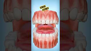 TONSIL STONES Stinks 🤮 [upl. by Yand]