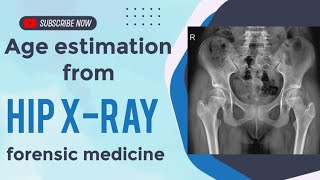 Age estimation using Hip X Ray FMT [upl. by Ayoras]