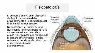 Glaucoma Angulo Cerrado  Dra Argeñal [upl. by Alanah419]