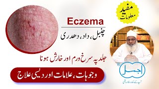 Chambal Dhadar ka ilaj  Eczema Herbal Treatment  Skin Allergy [upl. by Rodger]