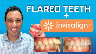 Invisalign Magic to Fix Flared Teeth WITHOUT EXTRACTION by Dr Robert Passamano [upl. by Rebekkah]