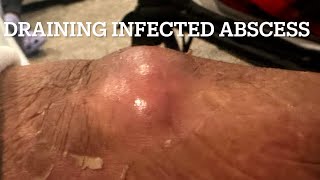 Draining my dad’s infected abscess [upl. by Culberson4]