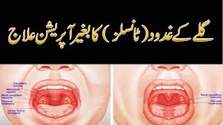 Homeopathic Treatment For Tonsils By Dr Naveed  Tonsil Ka Gharelu ilaj [upl. by Tabber426]