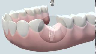 Cómo se coloca un implante dental [upl. by Airogerg220]