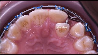 Double wire technique in orthodontic piggy back correcting cross bite [upl. by Akinot]