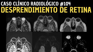 Caso clínico 104 Desprendimiento de retina [upl. by Ynaffat]