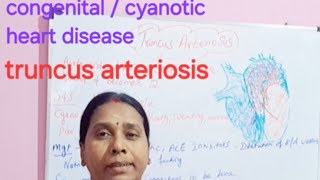 congenitalcyanotic heart disease truncus arteriosis [upl. by Carny]