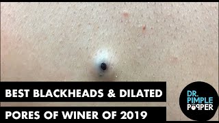 Best Of Blackheads and Dilated Pores of Winer for 2019 [upl. by Allehc]