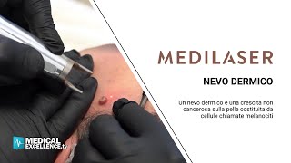 Vaporizzazione di un nevo dermico con laser CO2 efficace e indolore [upl. by Eioj]