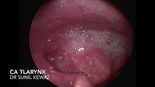 Carcinoma Larynx  Rt Pyriform Fossa [upl. by Koch]