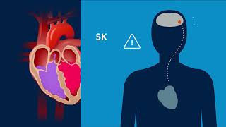 Atrial fibrillation symptoms [upl. by Aremus]