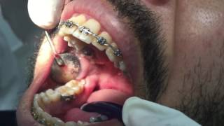 Extraction Dent De Sagesse Inférieure Incluse Centre Safi Smile [upl. by Manouch775]