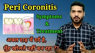 Peri coronitis  symptoms amp treatment  अक्ल दाढ़ दर्द का एक कारण [upl. by Adliw]