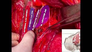 LUMBOSAKRAL PLEXUS VE PELVİK YAN DUVAR ANATOMİSİ LUMBOSACRALPLEXUS PELVICSIDEWALLANATOMY [upl. by Novrej]