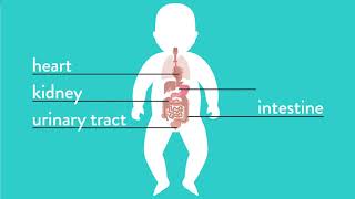 Conditions Explained Esophageal Atresia [upl. by Baillie799]