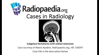 Subgaleal hematoma with orbital extension Radiopaediaorg Cases in Radiology [upl. by Petras977]