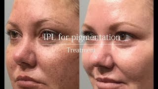 IPL for pigmentation  treatment video [upl. by Anali684]