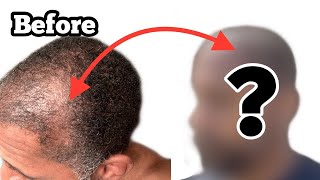 5 MONTHS POST OP HAIR TRANSPLANT  ASLI TARCAN HAIR CLINIC [upl. by Kries]