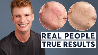 Acne Scar Removal  Real People True Results [upl. by Eslehc541]