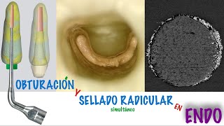 Curso Obturación Apical y Sellado Radicular simultáneo en Endodoncia UNPL Argentina [upl. by Kina304]