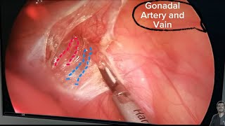 Laprascopic Varicocelectomy with audio comments [upl. by Marmawke921]