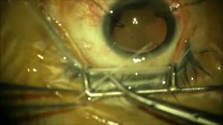 Management of traumatic cataract with 180 degree zonular dialysis and traumatic mydriasis [upl. by Rhtaeh]