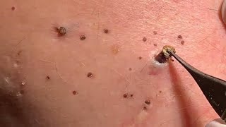 Blackhead removal [upl. by Selbbep]