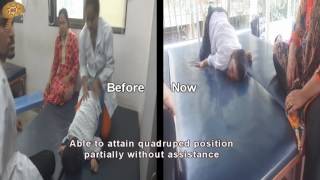 Dystonic Cerebral Palsy Treatment Results  Quick Look  No 3112 [upl. by Wester]