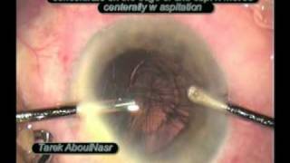 zonular dialysis  dehiscnece during phaco [upl. by Layton408]