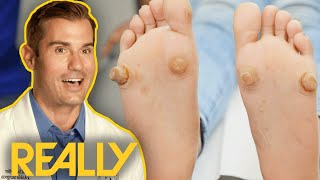 Dr Brad Blown Away By Severe Foot Growths  My Feet Are Killing Me [upl. by Emmaline136]