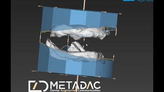 Digital Dentures Edentulous models [upl. by Cinimod]