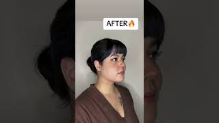 INSANE Chin Lipo RESULTS😱 chinlipo chinliposuction beforeandafter doublechin doublechinremoval [upl. by Annaoj]